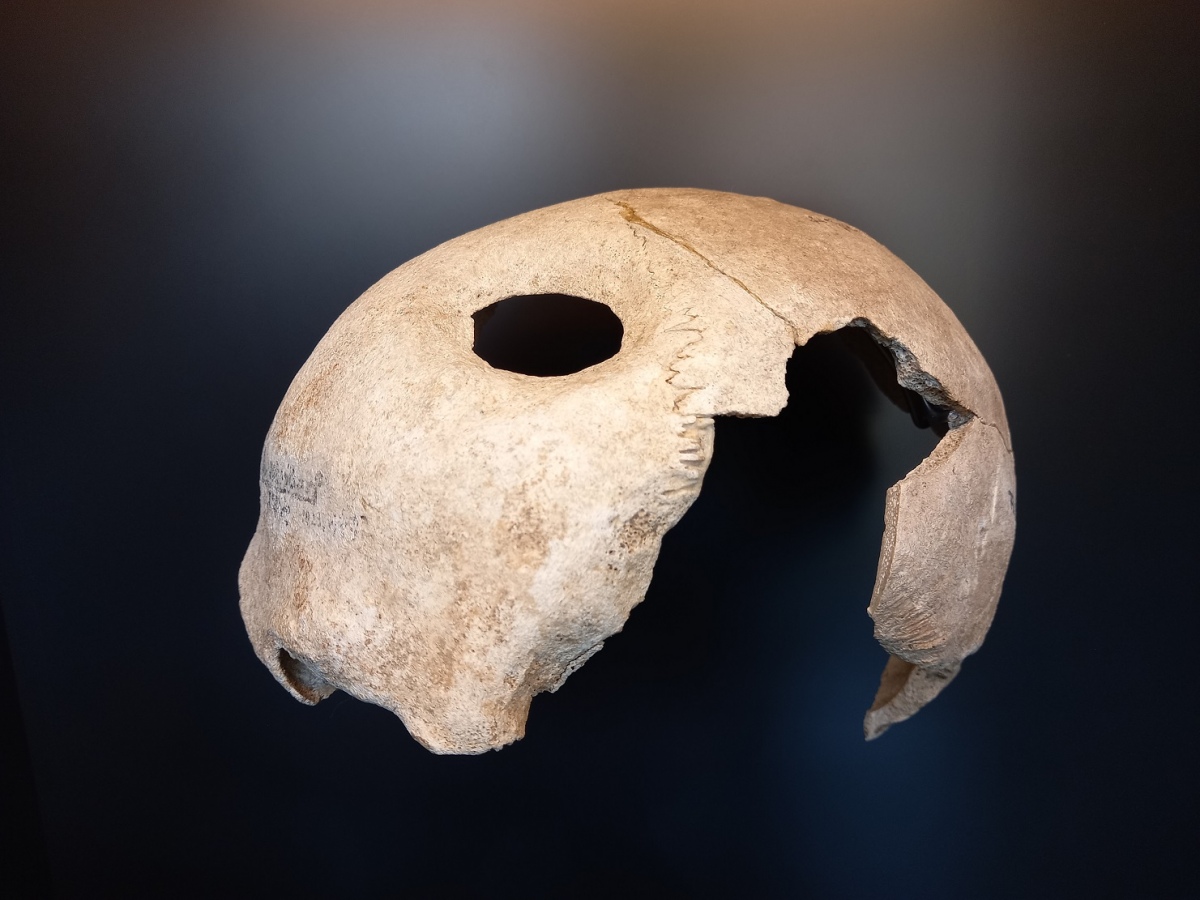 The skull of an adult man comes from a cemetery on the eastern shore of
the Parsteinsee Lake and dated to the transition period between the Neolithic
period and Bronze Age. The oval hole
in the forehead is the result of a medical
intervention to remove a foreign object
or to reduce pressure inside the skull
following an injury. Healing processes
on the bone around the hole prove that
the p